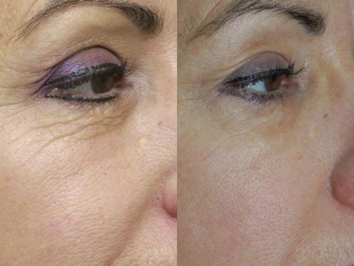 ojos antiarrugas