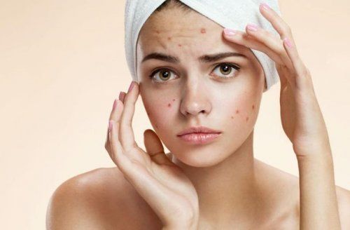 acne juvenil(1)