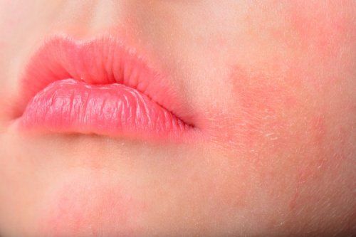 piel atopica