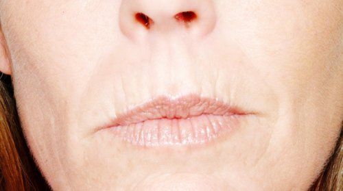 antiarrugas labios