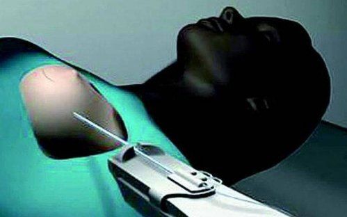 radioterapia