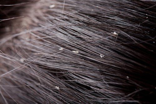 cabello con caspa 500x334